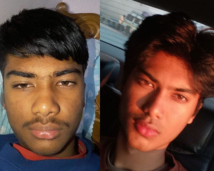 Before and after facial aesthetics results